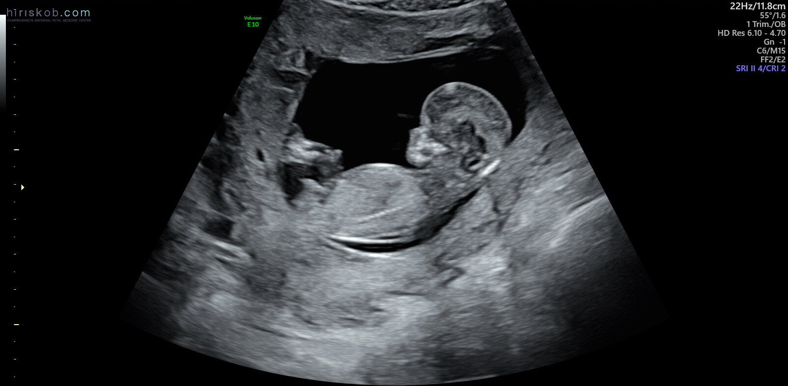 Baby boy scan pictures at 12 weeks