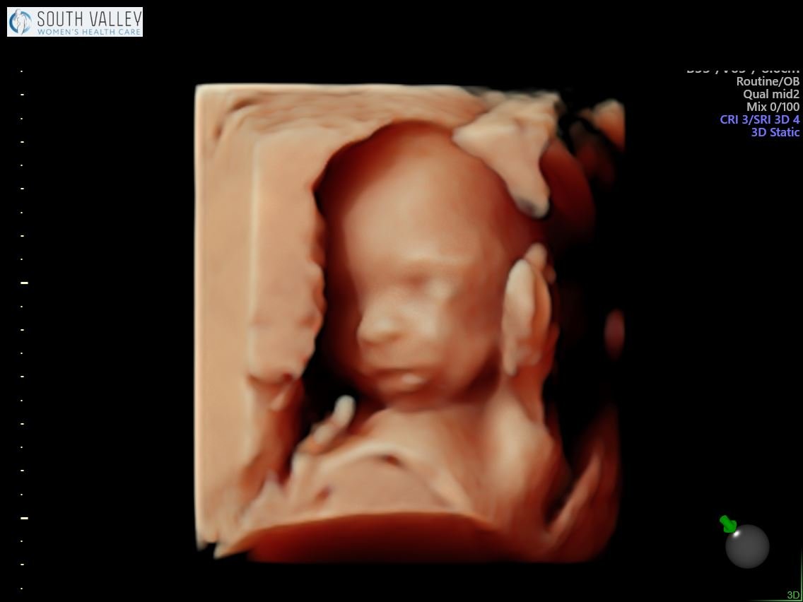 19 Weeks Ultrasound - Anatomy Scan 4D Images