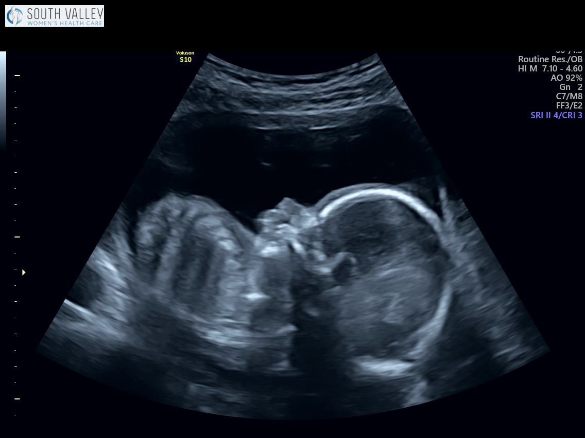 19 Weeks Ultrasound - Anatomy Scan 4D Images