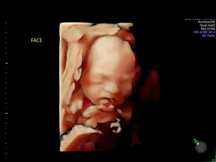 23 Weeks Ultrasound 23-weeks-ultrasound