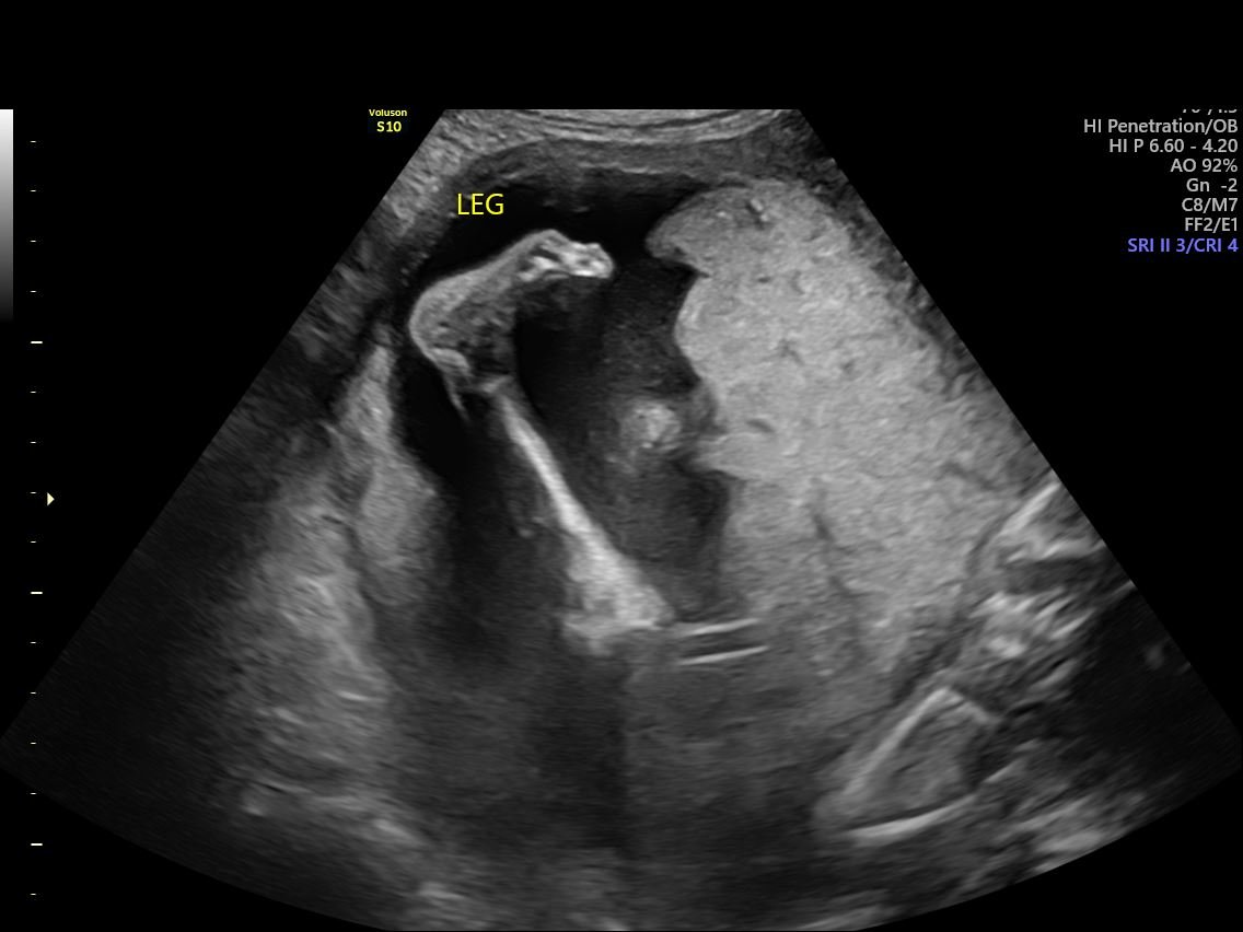 23 Weeks Pregnant | 4D Ultrasound + Bump Photos