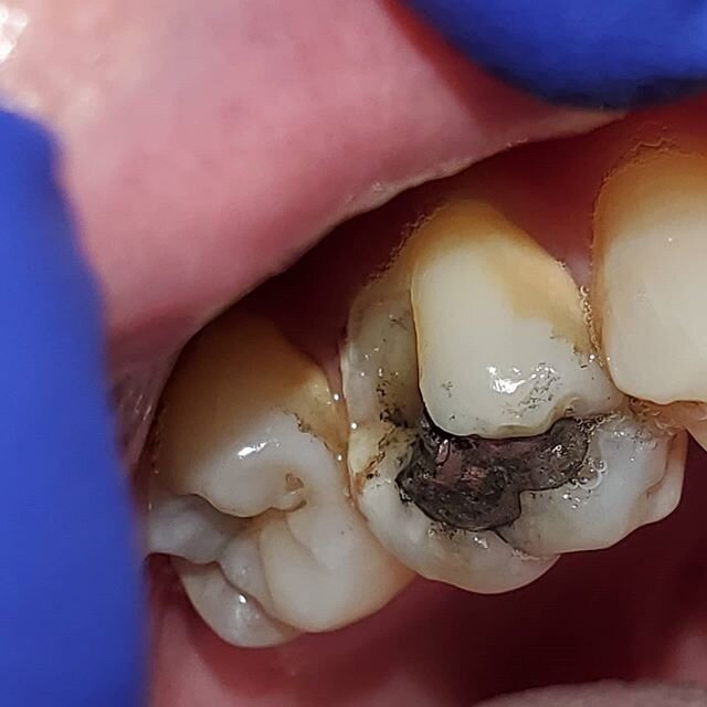 When cracklines appear around fillings (in this case a silver/amalgam filling), it is often a sign of underlting structural problems with the tooth. Talk to your dentist about a long term solution before it breaks and it is unable to be fixed.