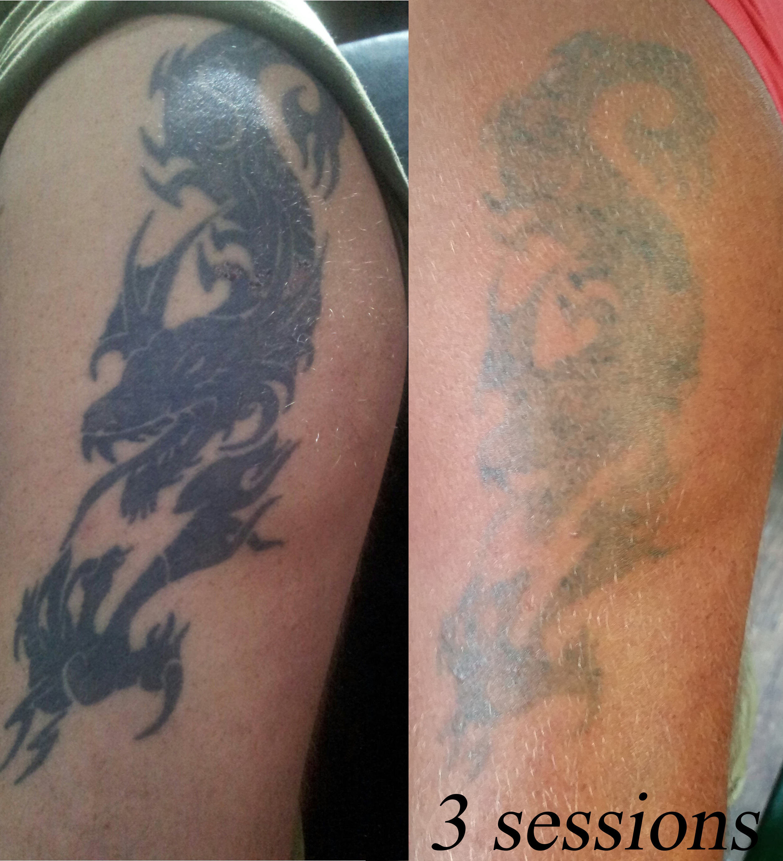 Tattoo Removal Laser services  Get Inked at DevilArtStudio The Best Tattoo  Studio in PakistanGet Inked at DevilArtStudio The Best Tattoo Studio in  Pakistan