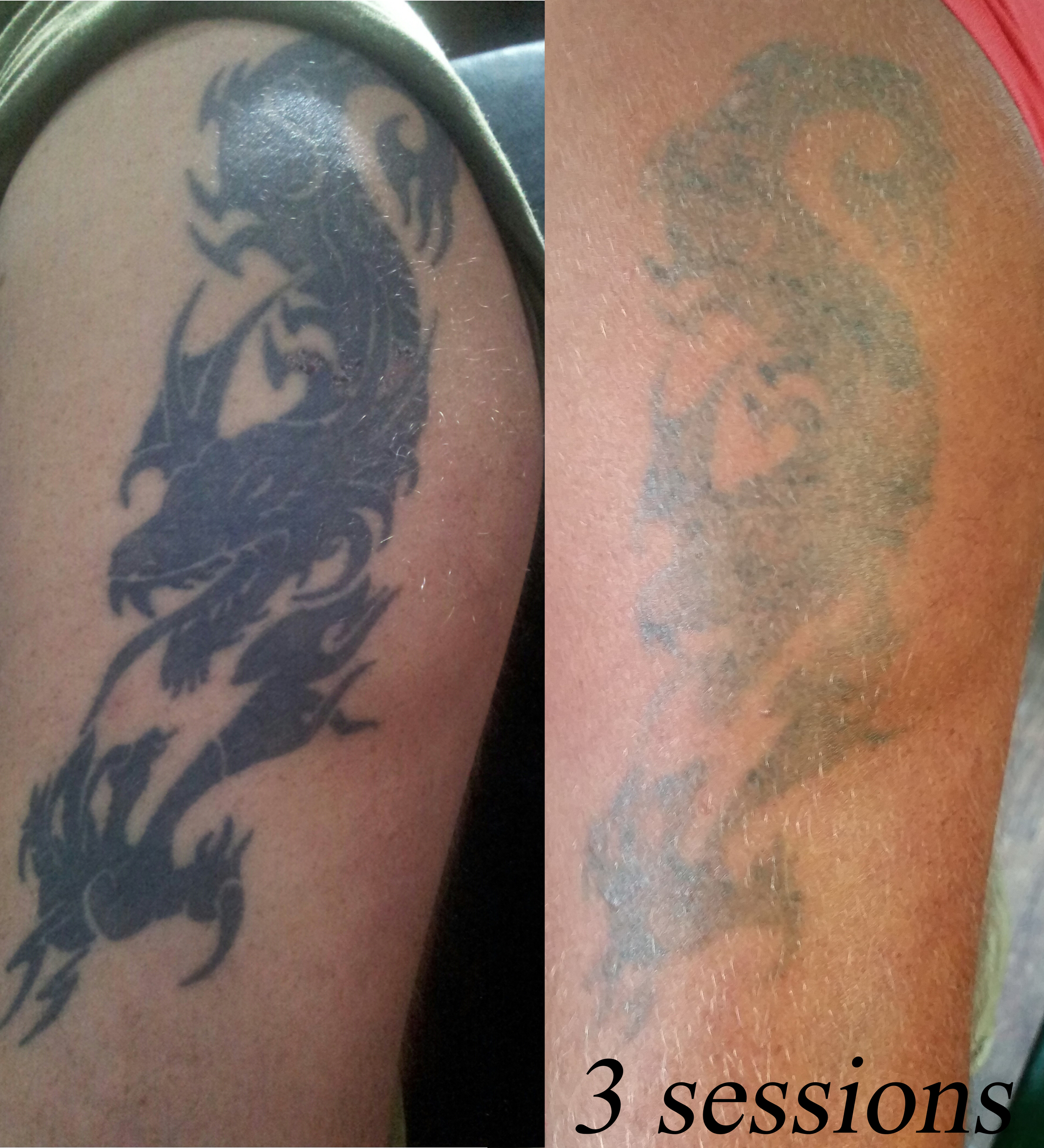 Laser Tattoo Removal — Bluefire tattoo