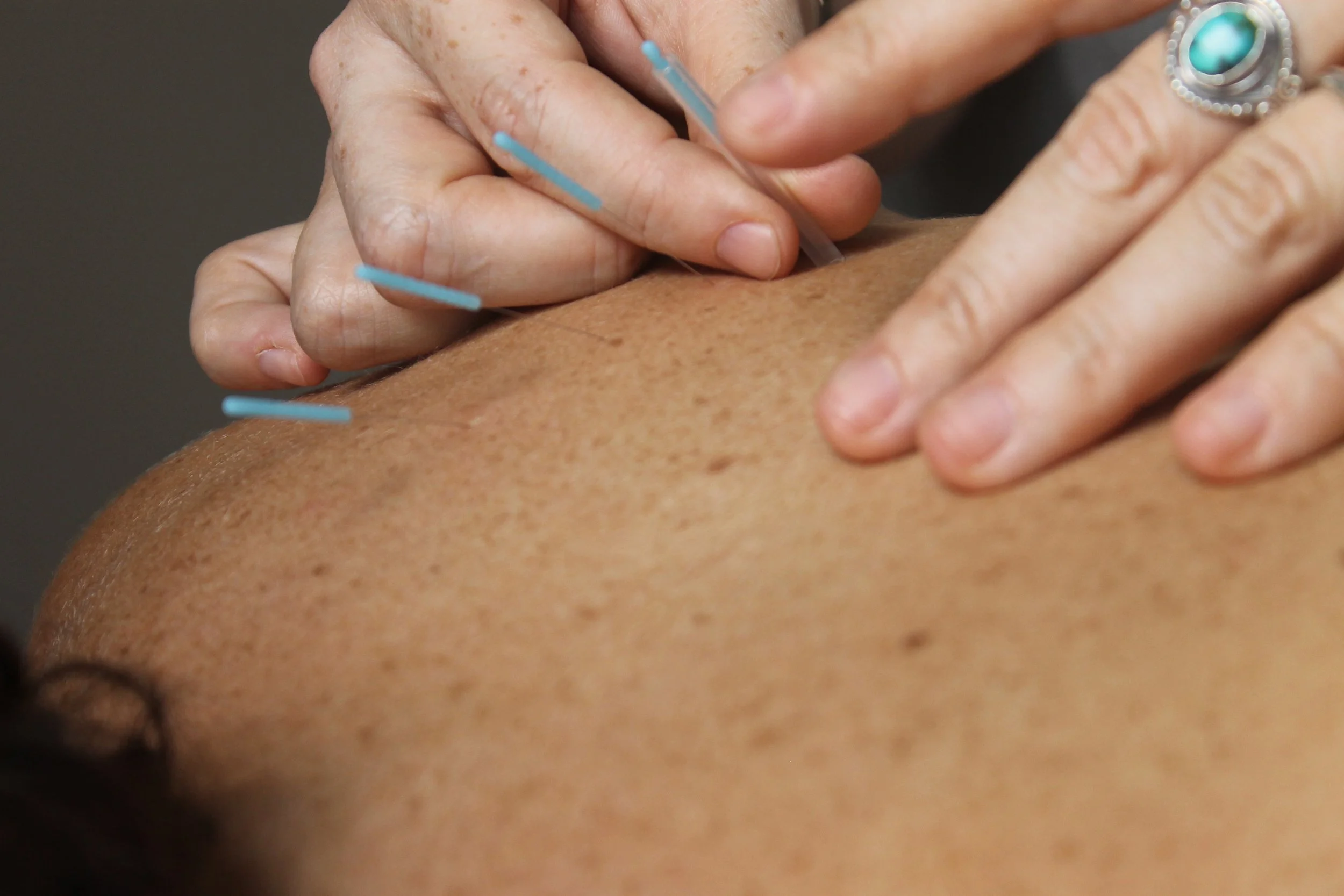 Top 5 Most Common Questions About Acupuncture Answered