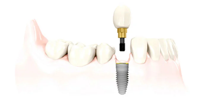 single-tooth-implant-new-westminster.jpg