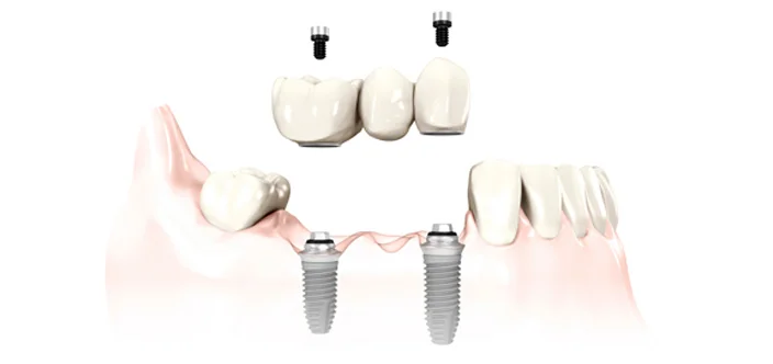 Multiple-Dental-Implants-New-Westminster.jpg