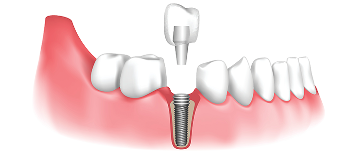 dental-implant.webp
