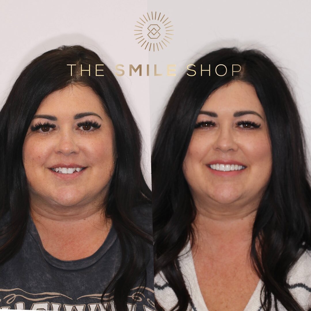 REAL PATIENT REVIEW 
⭐️⭐️⭐️⭐️⭐️
I absolutely love my teeth and smile!! So happy I finally had them done. I wish I hadn't waited so long. Super happy ❤️

Thankful for awesome patients that trust me with their smiles! See her before &amp; after closeup