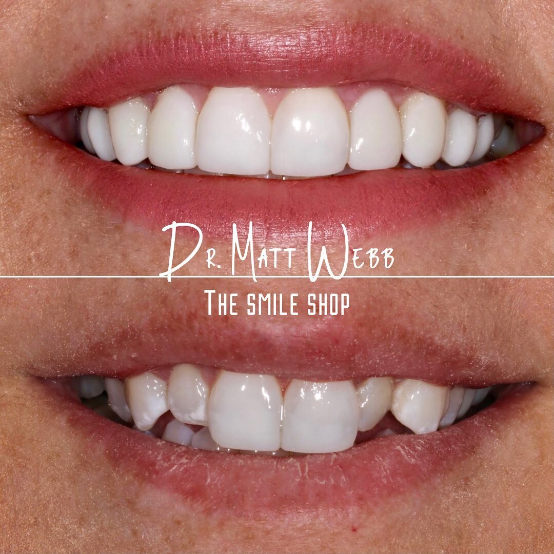 ✨COMPOSITE VENEERS✨
Save your healthy tooth structure by adding composite directly to your teeth without shaving them down.

Don&rsquo;t wait, invest in your happiness! A confident smile can go anywhere with you! 
LINK IN BIO

#composite #compositeve