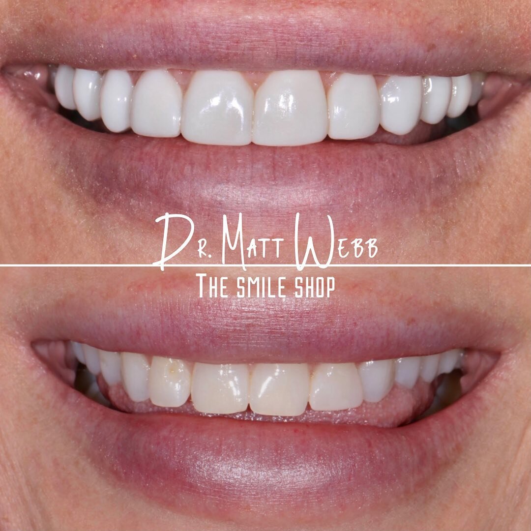 ✨COMPOSITE VENEERS✨
Composite bonding is a noninvasive treatment that can transform your smile (WITHOUT SHAVING DOWN TEETH) into the Bright &amp; Beautiful smile you were always wanting!

Follow the LINK IN BIO for a complimentary virtual consult.

#