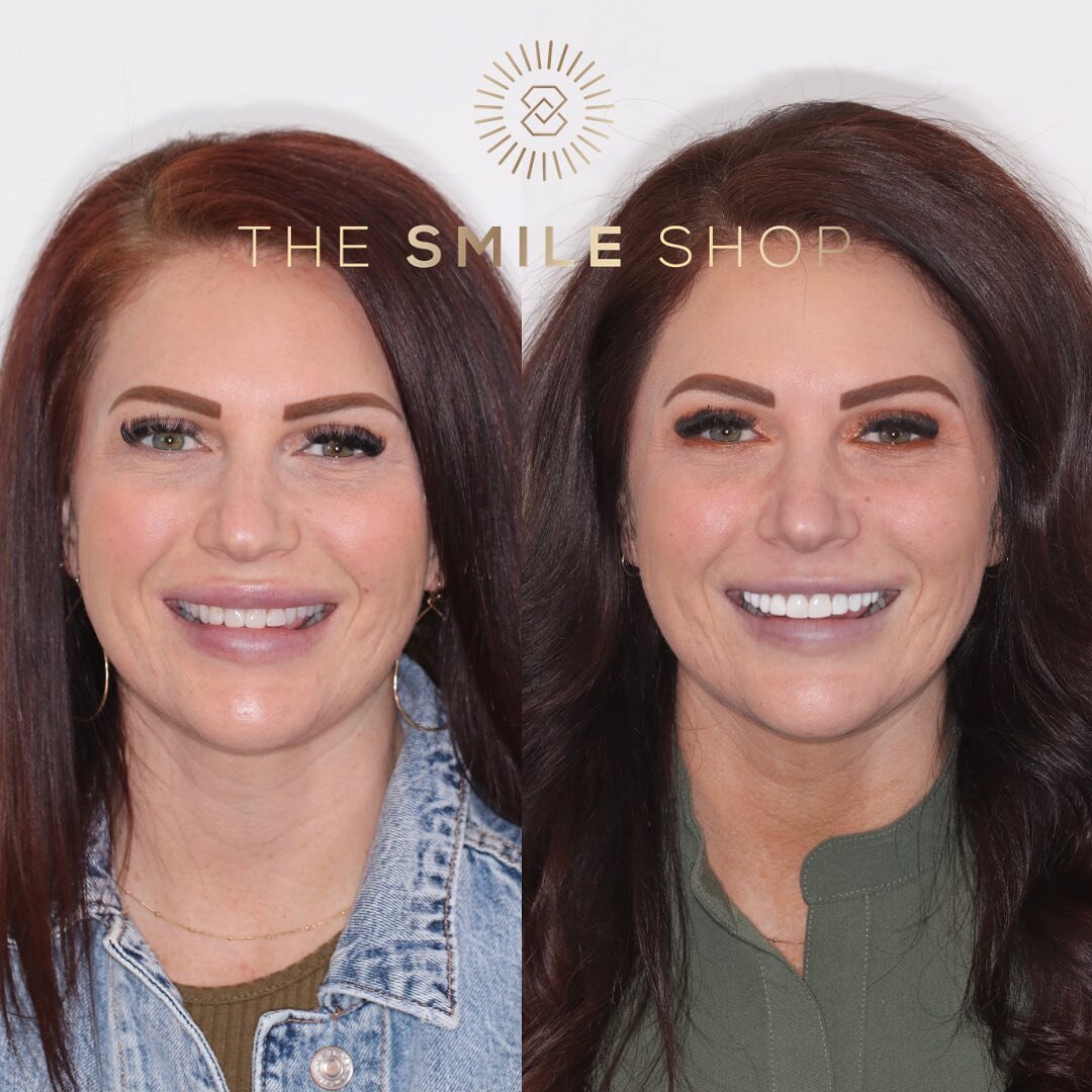 &ldquo;I have been so happy with my teeth. I don't think I've smiled this much in my entire life!&rdquo;

Love seeing my patients smile with confidence!
Follow link in bio for a FREE VIRTUAL CONSULT.

#thesmileshop #loveyoursmile #composite #veneersw