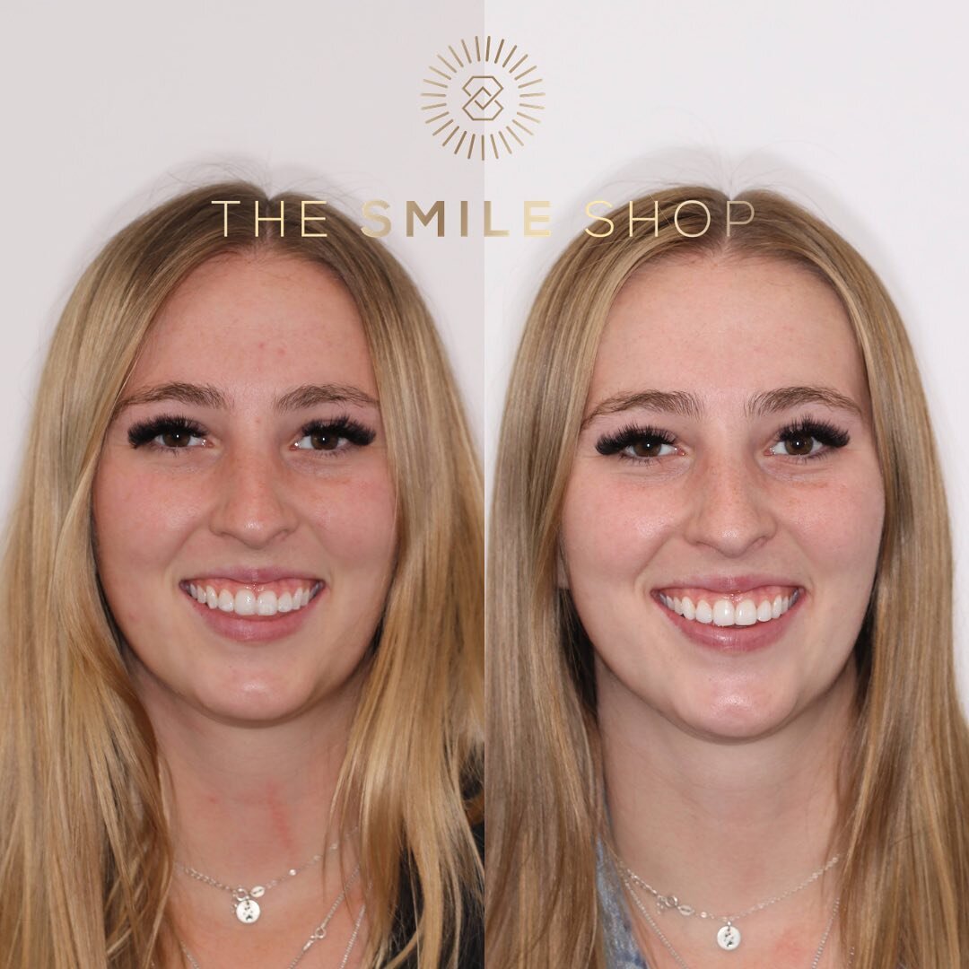 Simple changes can make a huge difference in your smile and in your confidence! What&rsquo;s holding you back from smiling with confidence? See her before and after closeup in my previous post.

Follow the LINK IN BIO for a complimentary virtual cons