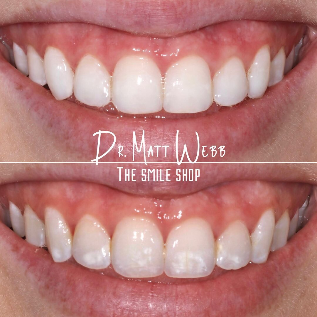 ✨COMPOSITE BONDING✨ 
Do you have white spots on your teeth? This is usually due to a calcium deficiency in the enamel.
We can remove the &ldquo;white spots&rdquo; from teeth in a minimally invasive way and restore the teeth with composite.
It&rsquo;s
