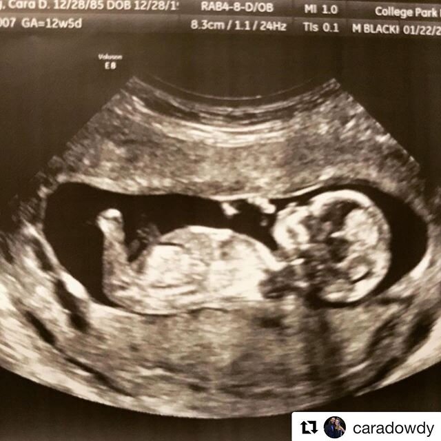 Dowdy Baby #4 is on the way. 😊
・・・
#Repost @caradowdy
・・・
The most beautiful sight. ❤️ Hello sweet Baby! We can&rsquo;t wait to meet you in July!