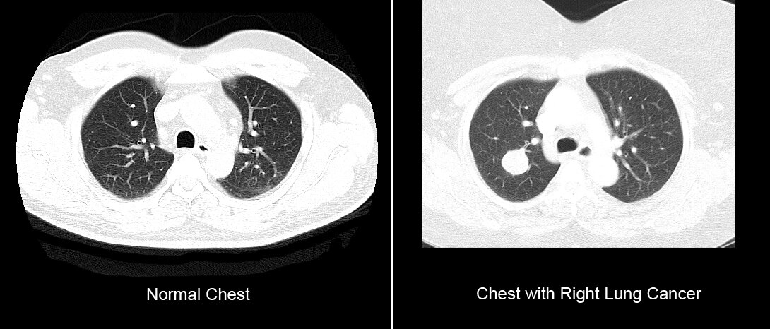 Lung Cancer 5.jpg