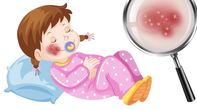 Eczema Chez L Enfant Dr Anne Marie Paverani Cabinet De Medecine Nutritionnelle Anti Age Et Micronutrition Corse Paris