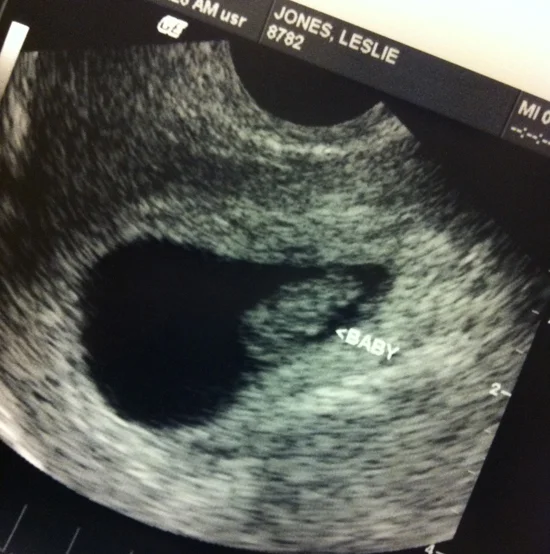 baby-ultrasound-eight-weeks