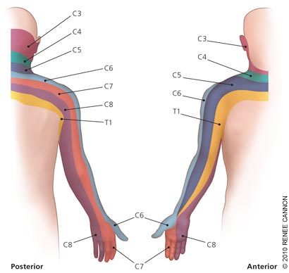 The cervical nerve roots extend in your arms and head, which were all irritated by the prolotherapy.