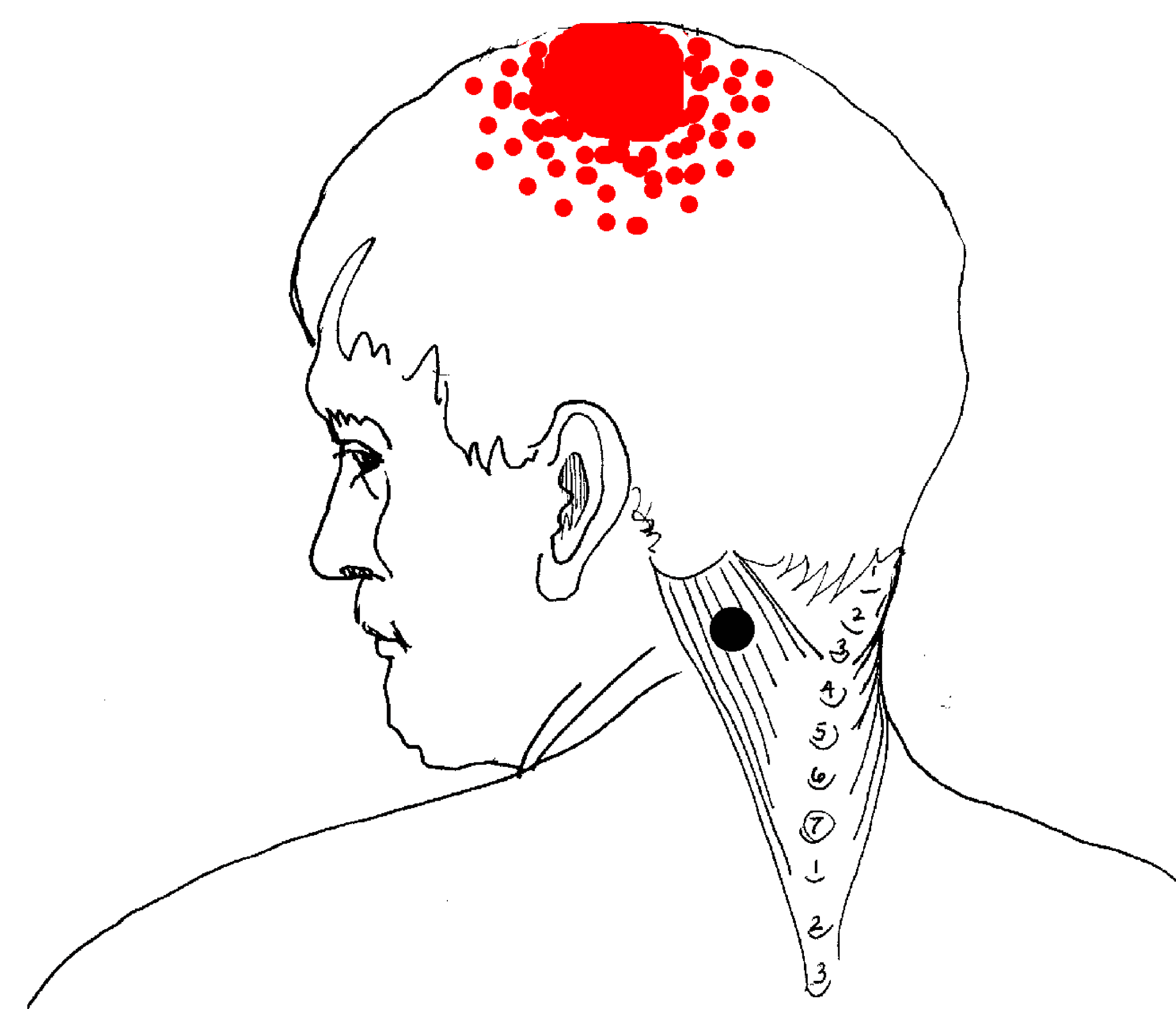The black dot represents the location of the trigger point and the red dots are the corresponding pain locales. 