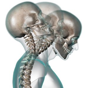 (Source: http://www.physiospot.com/wp-content/uploads/2013/06/whiplash-image.jpg)