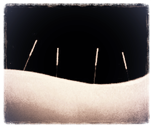 Dry Needling / Acupuncture