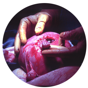 Baby Samuel&nbsp;grasps&nbsp;the&nbsp;surgeon’s&nbsp;finger during an in utero operation.