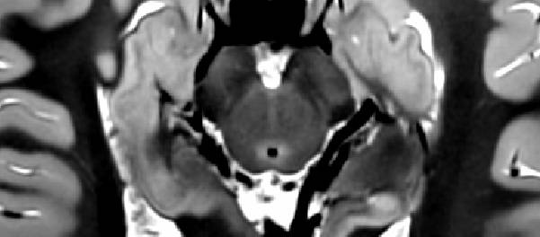 MRI scan of hippocampus (coronal)