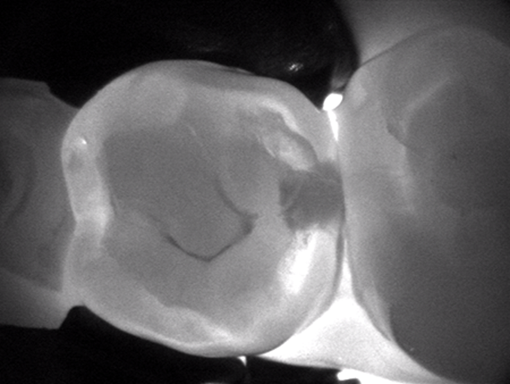 Bellevue Dental Arts Dexis Carivu tooth decay detection