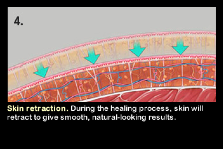 VaserLipo4.png