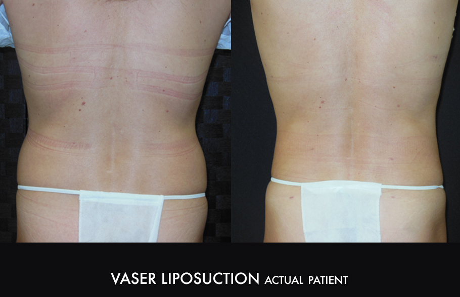 Vaser Liposuction Northern Colorado