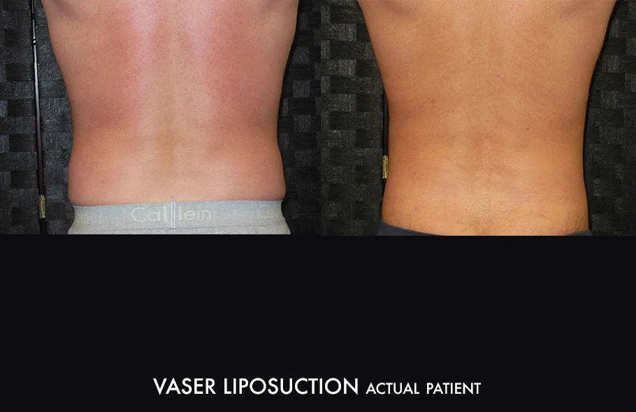 Dr. Kirk Northern Colorado Vaser Liposuction