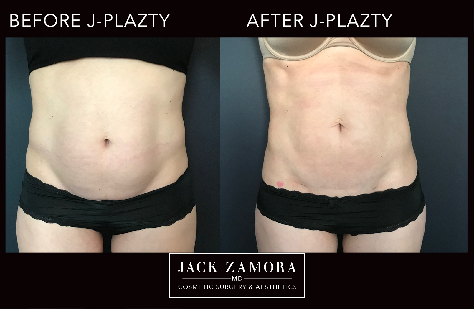 J-Plazty_Body_4_Post_2weeks_Front.jpg