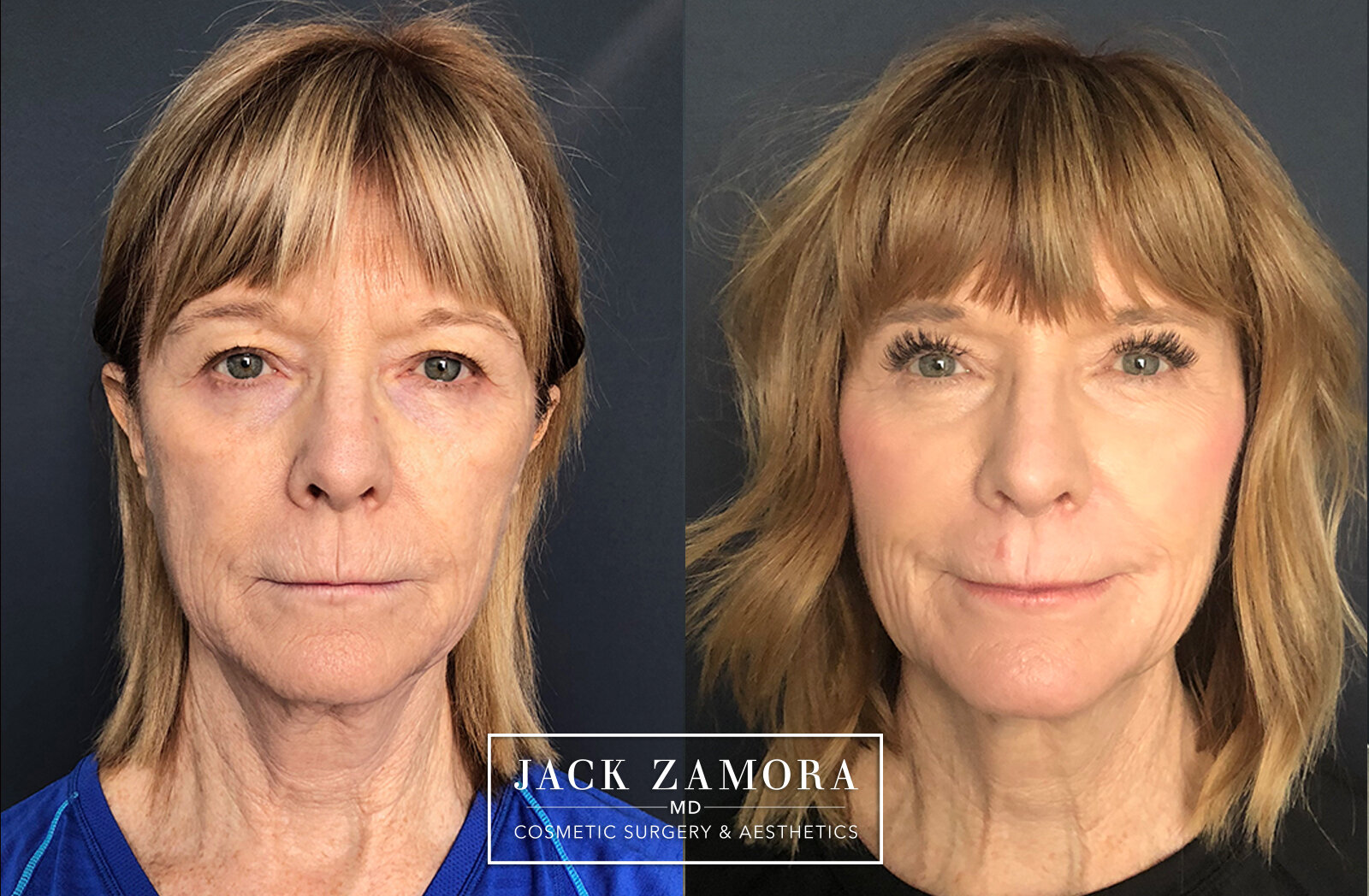 Fat Transfer with Facelift and Laser Resurfacing by Jack Zamora, MD