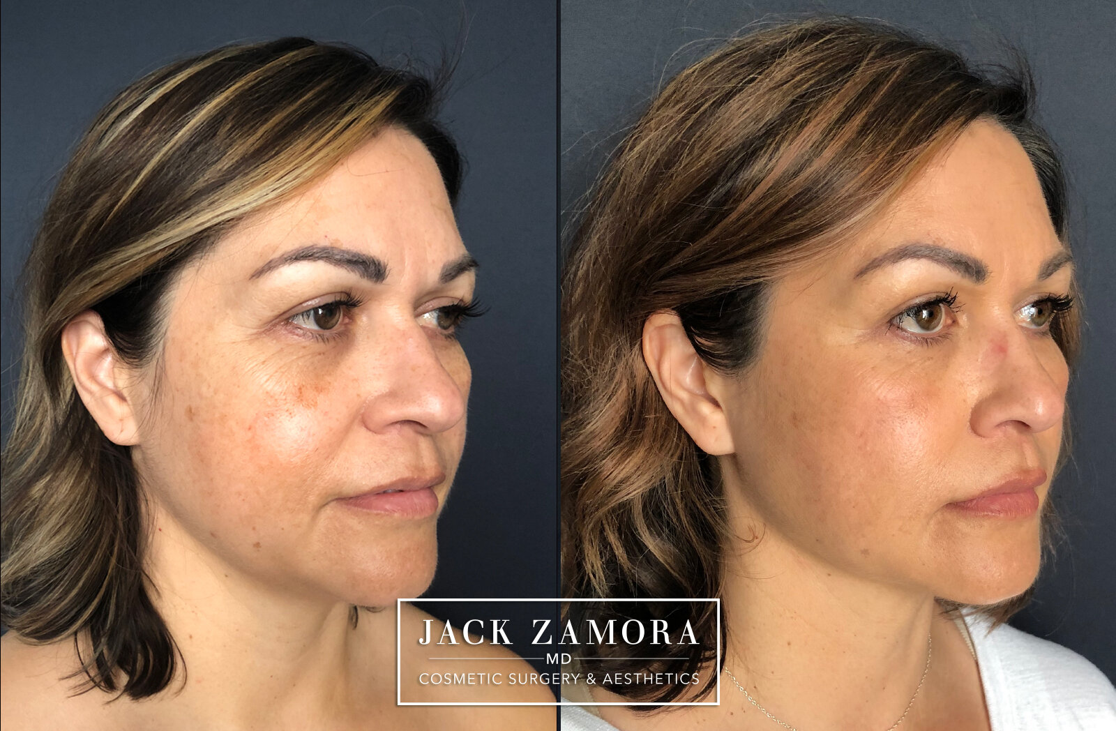 Facial Fat Transfer by Dr. Zamora