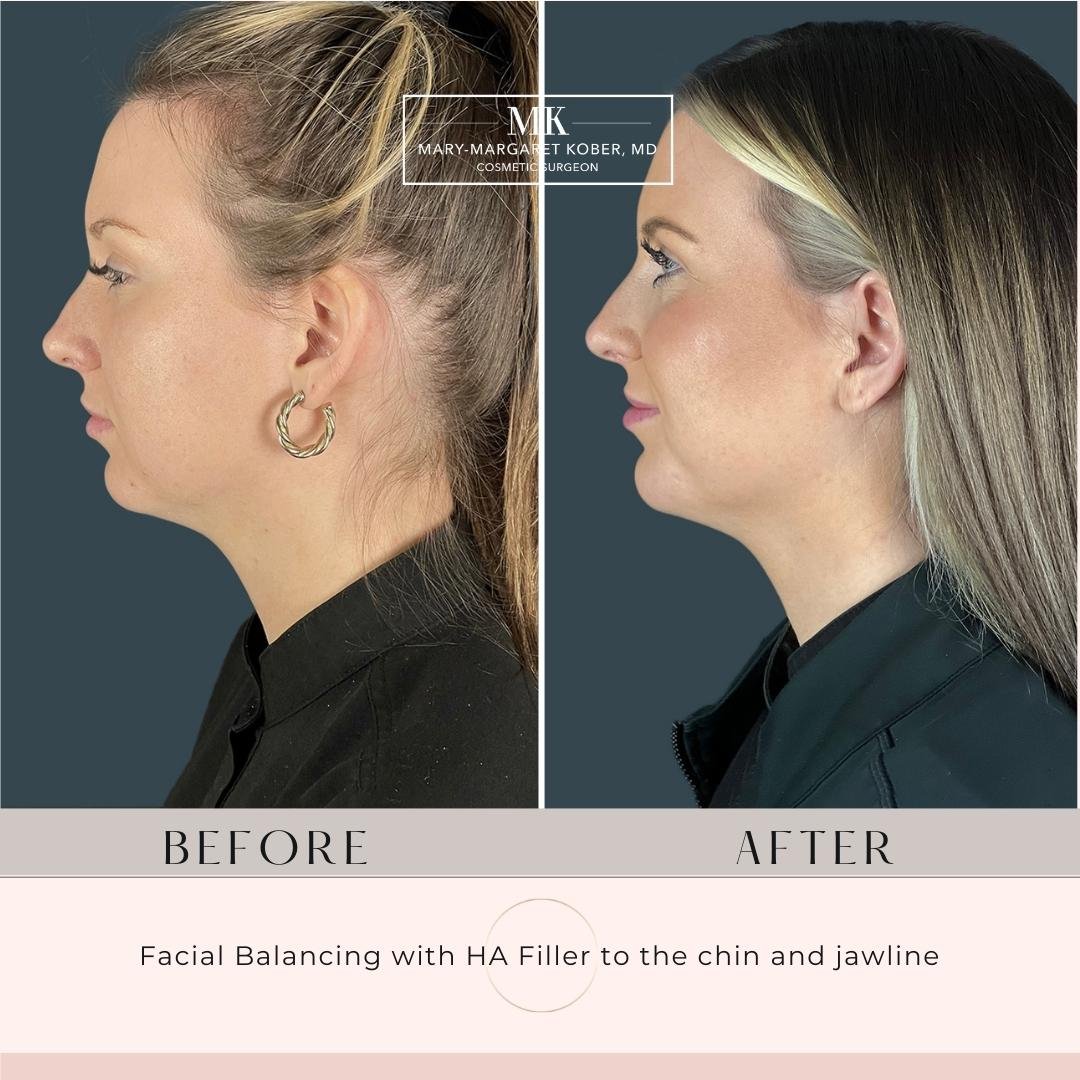 Chin and jawline filler with Dr. Maggie Kober in Denver Colorado