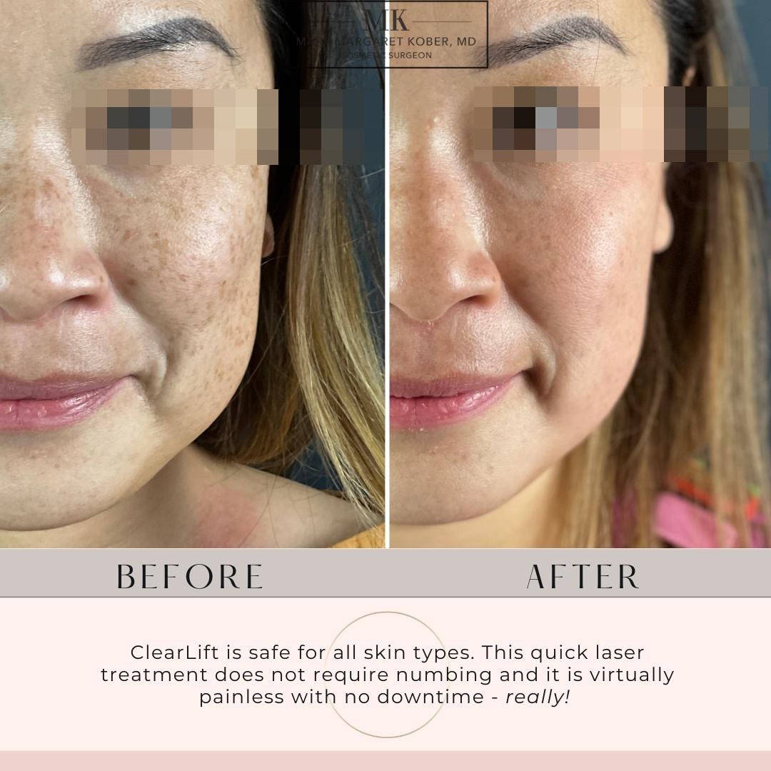 ClearLift Laser Before and After
