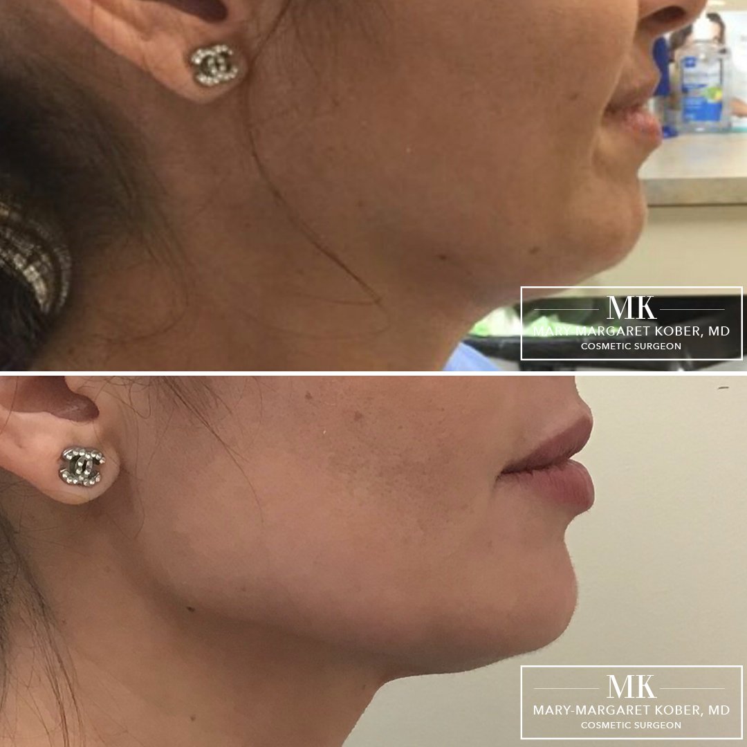 Jawline Filler Before and After