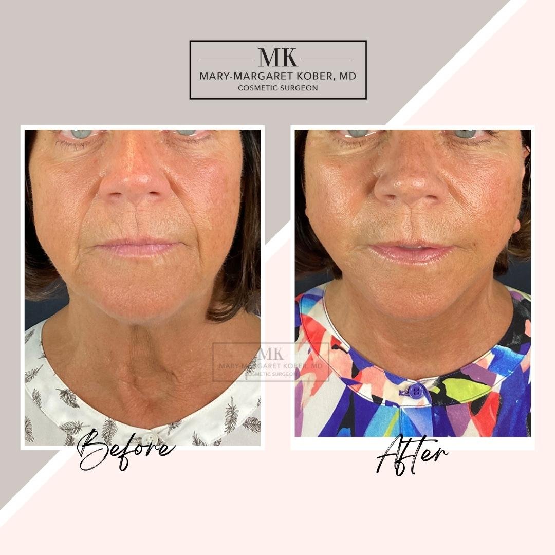 J-Plazty Facelift Before and After by Dr. Maggie Kober