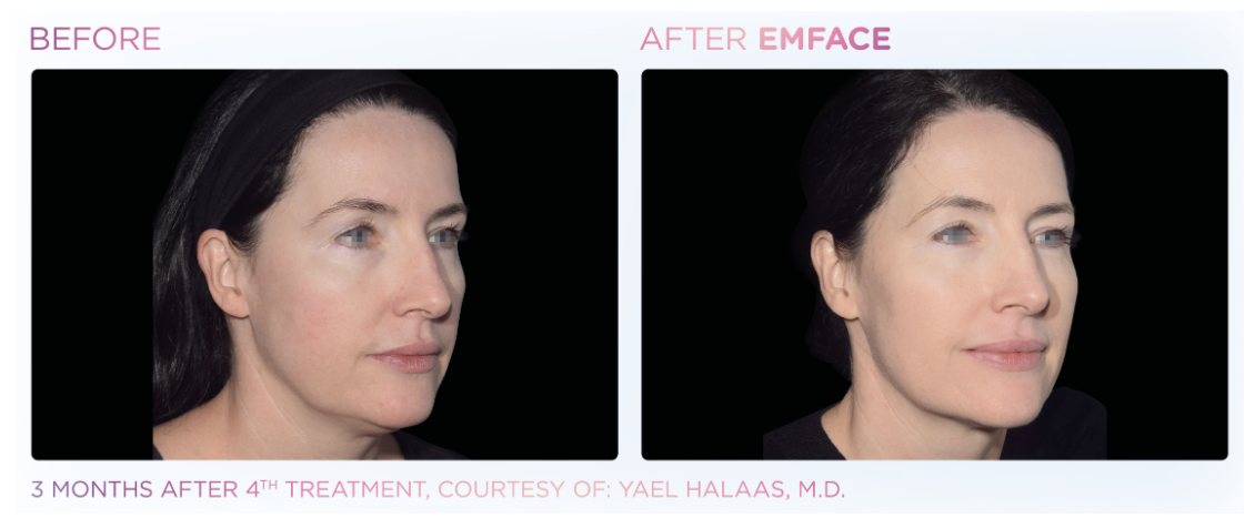 EMFACE lifts and tones facial muscles