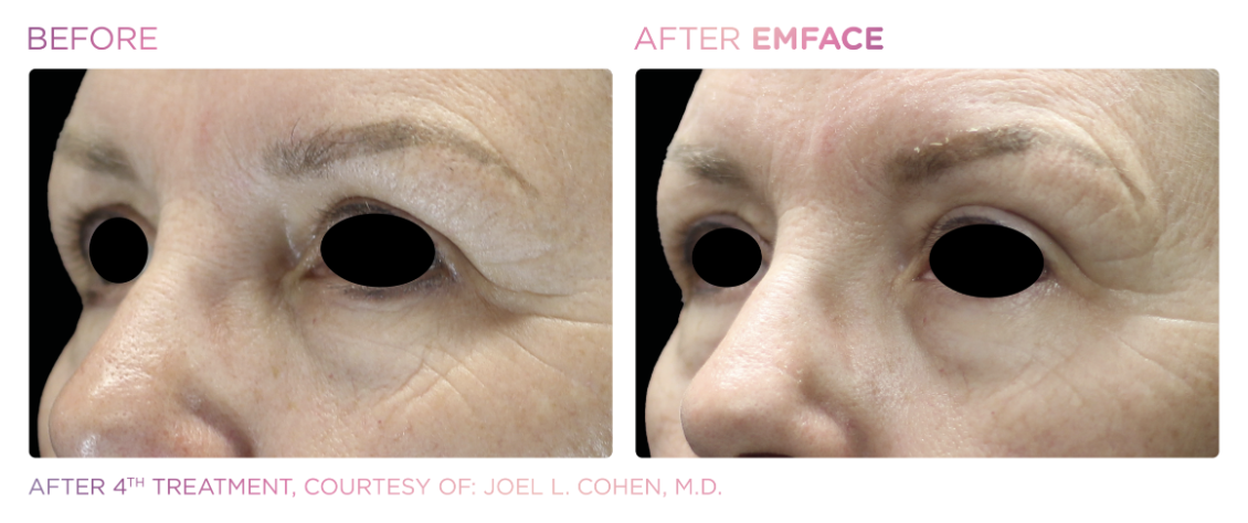 Non-surgical eye lift with EMFACE