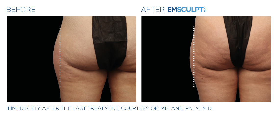 Jack Zamora MD Emsculpt NEO Outer Thigh 1.png