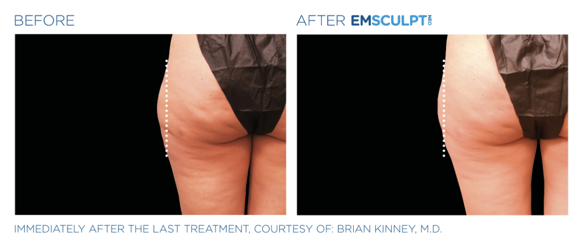 Jack Zamora MD Emsculpt NEO Outer Thigh 2.png