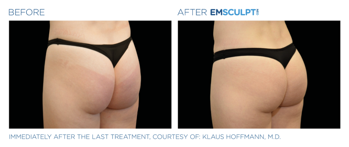 Jack Zamora MD Emsculpt NEO Glutes.png