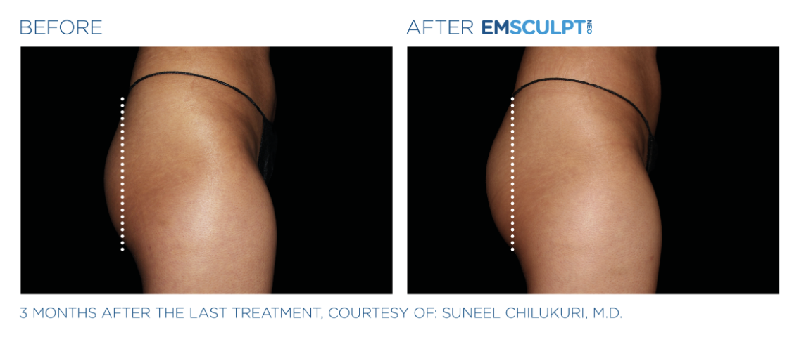 Jack Zamora MD Emsculpt NEO Glutes 2.png