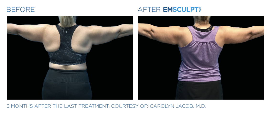 Jack Zamora MD Emsculpt NEO Arms 2.png