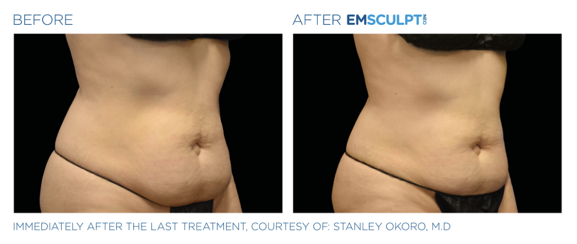 Jack Zamora MD Emsculpt NEO Abdomen 1.png