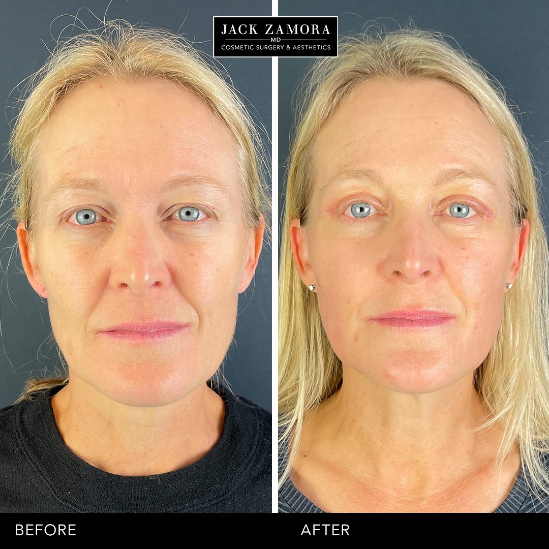 Upper Eyelid Lift with Laser Resurfacing and Exosome Serum by Jack Zamora, MD