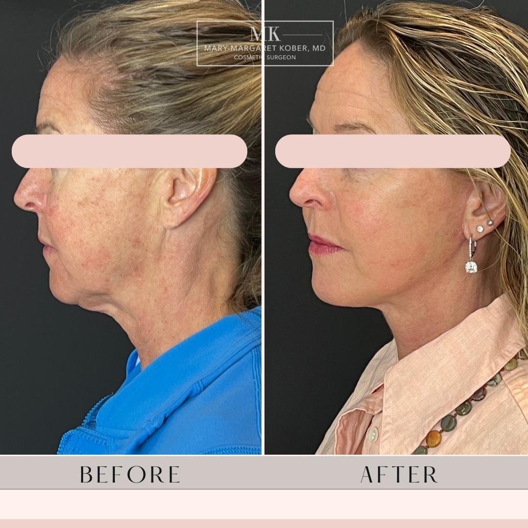 Lower face and neck lift with fat transfer