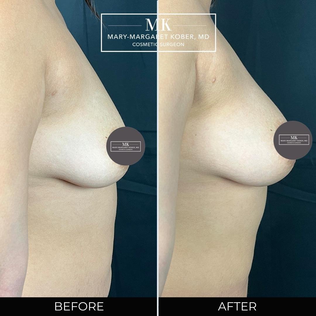 Fat grafting to breast 